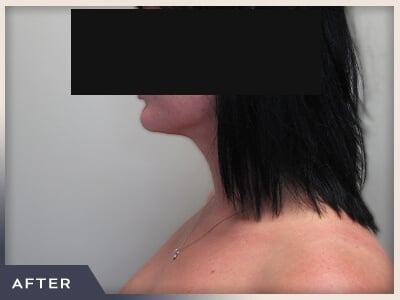 Neck Liposuction Before & After Patient #802