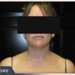 Neck Liposuction Before & After Patient #801