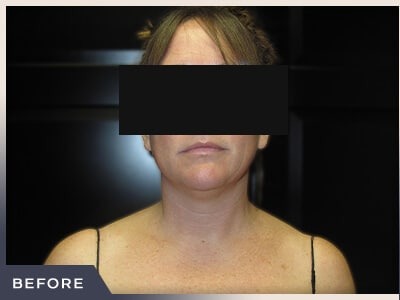 Neck Liposuction Before & After Patient #801