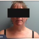 Neck Liposuction Before & After Patient #801