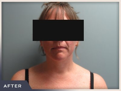 Neck Liposuction Before & After Patient #801