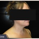 Neck Liposuction Before & After Patient #801