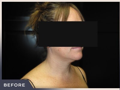 Neck Liposuction Before & After Patient #801