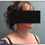 Neck Liposuction Before & After Patient #801