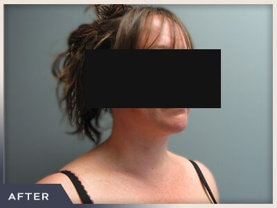 Neck Liposuction Before & After Patient #801