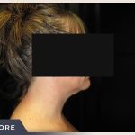 Neck Liposuction Before & After Patient #801