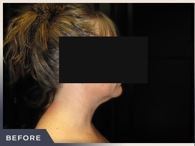 Neck Liposuction Before & After Patient #801