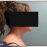 Neck Liposuction Before & After Patient #801