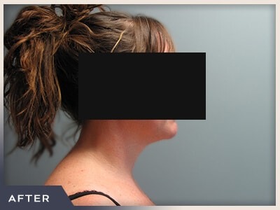 Neck Liposuction Before & After Patient #801