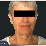 Neck Lift Before & After Patient #800