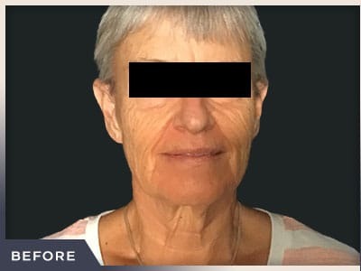 Neck Lift Before & After Patient #800