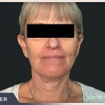 Neck Lift Before & After Patient #800