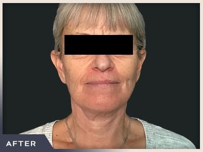 Neck Lift Before & After Patient #800