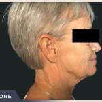Neck Lift Before & After Patient #800