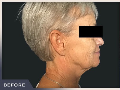 Neck Lift Before & After Patient #800