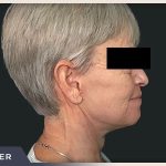 Neck Lift Before & After Patient #800
