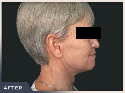Neck Lift Before & After Patient #800