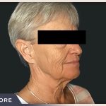 Neck Lift Before & After Patient #800