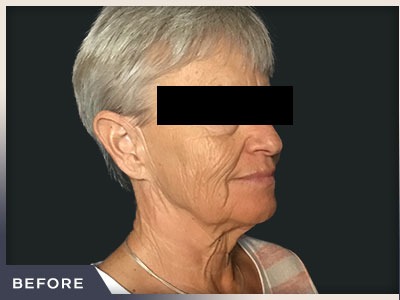 Neck Lift Before & After Patient #800
