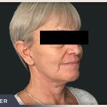 Neck Lift Before & After Patient #800