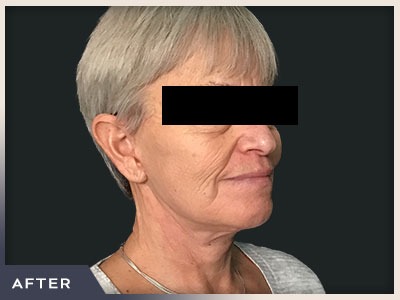 Neck Lift Before & After Patient #800