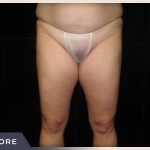 Liposuction Before & After Patient #1416