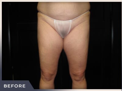 Liposuction Before & After Patient #1416