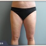 Liposuction Before & After Patient #1416