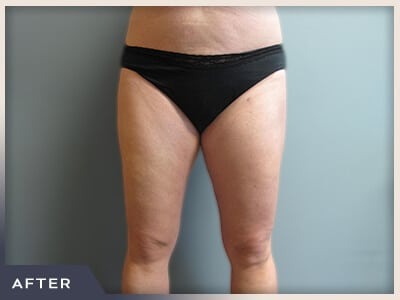 Liposuction Before & After Patient #1416