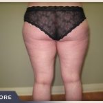 Liposuction Before & After Patient #1417