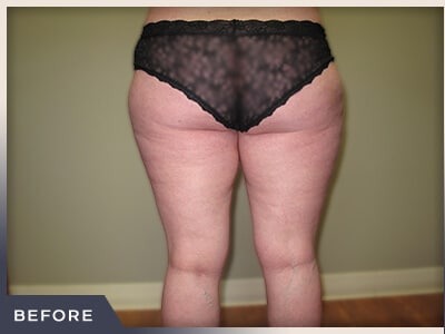 Liposuction Before & After Patient #1417