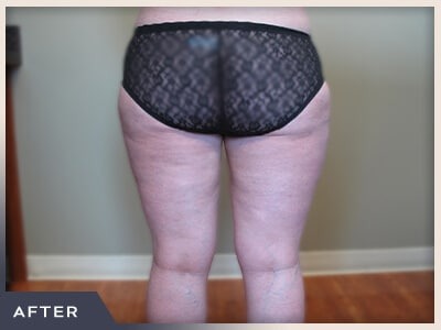 Liposuction Before & After Patient #1417