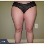 Liposuction Before & After Patient #1417