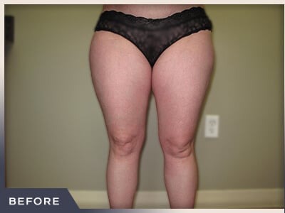 Liposuction Before & After Patient #1417