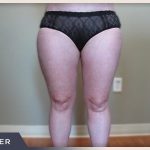Liposuction Before & After Patient #1417