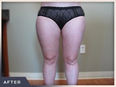 Liposuction Before & After Patient #1417