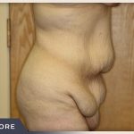 Massive Weight Loss Before & After Patient #1423