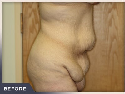 Massive Weight Loss Before & After Patient #1423