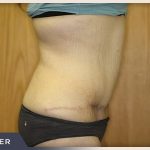 Massive Weight Loss Before & After Patient #1423