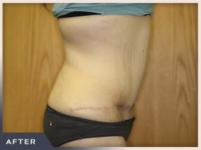 Massive Weight Loss Before & After Patient #1423