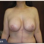 Massive Weight Loss Before & After Patient #1424