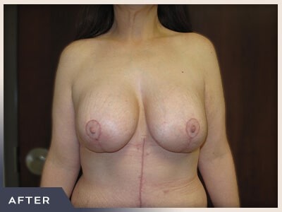 Massive Weight Loss Before & After Patient #1424