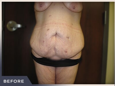 Massive Weight Loss Before & After Patient #1424