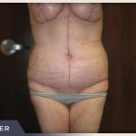 Massive Weight Loss Before & After Patient #1424