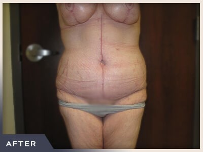 Massive Weight Loss Before & After Patient #1424