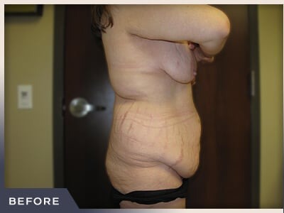 Massive Weight Loss Before & After Patient #1424