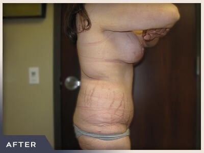 Massive Weight Loss Before & After Patient #1424