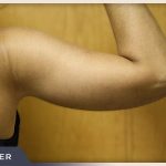 Massive Weight Loss Before & After Patient #780