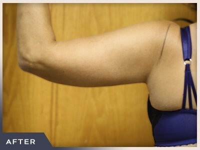 Massive Weight Loss Before & After Patient #780