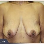 Massive Weight Loss Before & After Patient #780